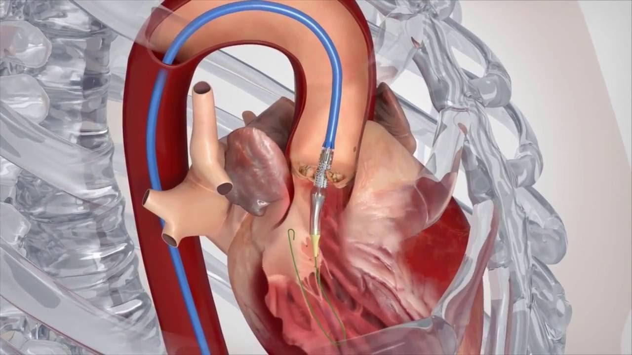 影响心脏瓣膜手术恢复的因素视频截图